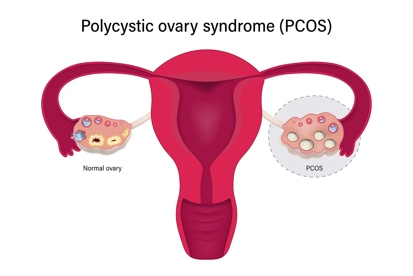 Polycystic Ovary Syndrome (PCOS) and Its Role in Female Infertility/ bulk medicine supplier
